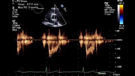 2d echo result